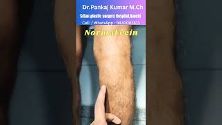 How normal veins looks  No treatment for normal veins vrin varicoseveins shorts youtubeshorts [upl. by Willard]