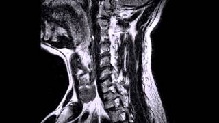 Cervical Spine Pain and Radiculopathy with disc protrusion MRI  San Leandro Chiropractor [upl. by Emelyne]