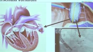 Herzrhythmusstörungen  Vorhofflimmern  Dr Wirth  SLK [upl. by Kenimod913]
