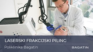 Laserski frakcijski piling  Poliklinika Bagatin [upl. by Larner]