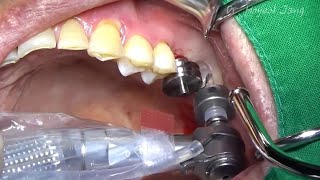 Flapless implant placement using Guide kit amp Crestal sinus lift [upl. by Leunas]