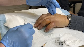 Drainage of blisters secondary to frostbite [upl. by Hiroshi]