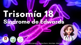 Trisomía 18 ‐ Síndrome de Edwards [upl. by Magdalena]