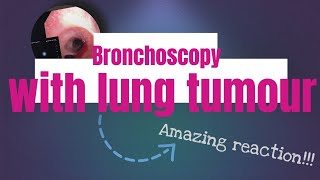 Bronchoscopy with lung tumour [upl. by Zetneuq]