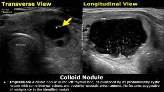 Thyroid Ultrasound Reporting  How To Write USG Scan Reports  Thyroid Pathologies  Small Parts USG [upl. by Norvan]