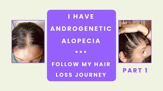 Androgenetic Alopecia in Women – My Hair Loss Journey – Part 1 [upl. by Guerin]