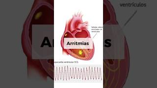 ARRITMIAS CARDÍACAS [upl. by Dis]