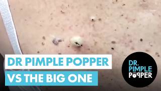 Dr Pimple Popper vs THE BIG ONE [upl. by Britta]