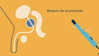 Les examens pour diagnostiquer et surveiller le cancer de la prostate [upl. by Asertal233]