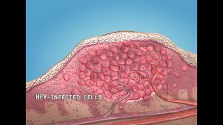 What are warts HPV  3D animation [upl. by Oiratno]