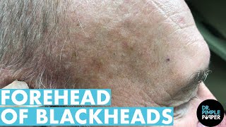 A Forehead of Blackhead Extractions Dr Pimple Popper Mines a Patients Head [upl. by Ardekan512]