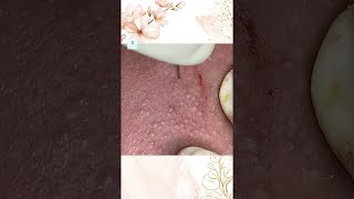 Big Cystic Acne Blackheads Extraction Blackheads amp Milia Whiteheads Removal Pimple Popping shorts [upl. by Oivaf566]