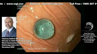 Endoscopic procedure for foreign body removal [upl. by Lellih746]