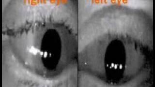 Eye Movevement Examples [upl. by Carrnan]