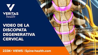 Video de la discopata degenerativa cervical [upl. by Haraf856]