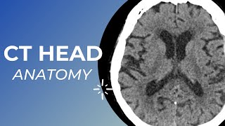 CT head anatomy for Medical students  residents and clinicians [upl. by Warren985]