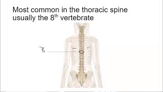 Hemivertebrae [upl. by Glyn20]