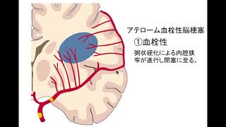 アテローム血栓性脳梗塞の3つの分類 [upl. by Marlette]