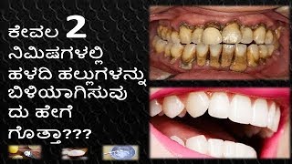 How To White Teeth In Kannada  Teeth Cleaning At Home In Kannada  Teeth Whitening in Kannada [upl. by Yecaw]