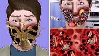 ASMR Remove maggot from infected man beard  ASMR Animation Treatment restasmr1 [upl. by Nilyram]