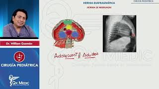 Malformaciones del diafragma Hernia de Morgagni  Cirugía en pediatría 2024 [upl. by Rotceh]