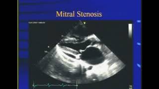 Mitral stenosis Dr S K Parashar [upl. by Hardunn526]