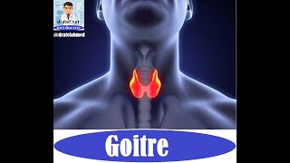 Goitre Thyroid Gland DiseasesCase Presentation  Medical Case Study Case Discussion Case Report [upl. by Sheela]