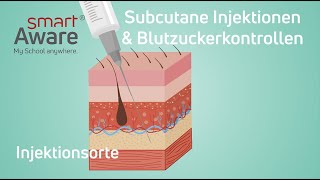 Subcutane Injektionen und Blutzuckermessung Injektionsorte  Fachfortbildungen Pflege [upl. by Eiramanna544]