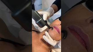 Non invasive CO2 fractional laser for skin resurfacing vaginal rejuvenation amp surgical application [upl. by Xel922]