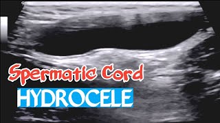 Ultrasound  Spermatic cord Hydrocele [upl. by Mae]