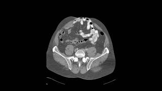 Péritonite  1 Diagnostic positif [upl. by Tillfourd]