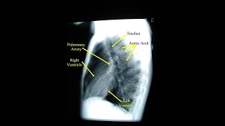 Lateral View of A Chest Xray  Definition structures and Uses [upl. by Nylitak]