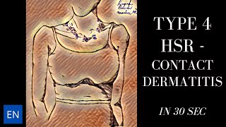 Type IV Hypersensitivity in Contact Dermatitis Shorts [upl. by Nageek804]