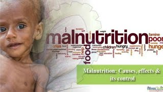 Malnutrition  Types and Classification  Symptoms And Treatment [upl. by Nnomae]