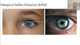 Ptosis Examination Clinical Skills in Ophthalmology [upl. by Maurene35]