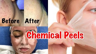 CHEMICAL PEEL TREATMENT  Glycolic Peel Salicylic Peel amp Lactic Peel  Chemical Peels In India [upl. by Les780]