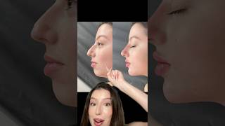 Filler before amp after filler lipfiller chinfiller nosefiller beforeandafter botox fillers [upl. by Weisberg153]