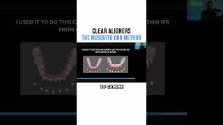 Clear Aligners The mosquito Bur Method [upl. by Girhiny]