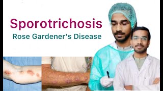 Sporotrichosis  Rose Gardeners Disease  Subcutaneous Mycosis [upl. by Oicnanev453]