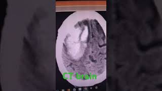 Intracranial hemorrhage ct brain short youtubeshorts [upl. by Ttreve]