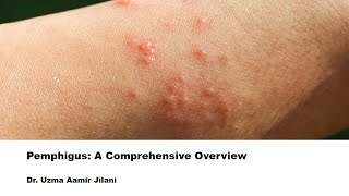 Understanding Pemphigus Causes Symptoms and Treatment of This Rare Autoimmune Skin Disorder [upl. by Anazraf]