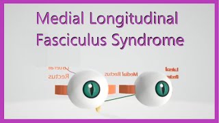 Medial Longitudinal Fasciculus Syndrome [upl. by Sverre906]