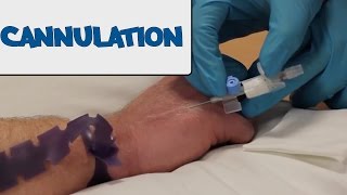 How to Perform Cannulation  OSCE Guide old version  UKMLA  CPSA [upl. by Iemaj]