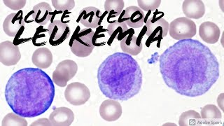 Acute Myeloid Leukemia AML w Monocytic Differentiation formerly AMML with Blasts amp Promonocytes [upl. by Thomey]