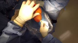 Plantar Fasciotomy [upl. by Gabriellia]