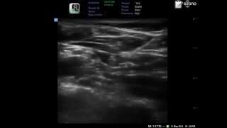 ultrasound guided supraclavicular brachial plexus block in one minute only [upl. by Menendez814]