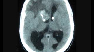 Frontal Intraventricular tumor with hydrocephalus [upl. by Rizzo930]