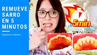 ¿Remover Sarro Dental en 5 minutos con Remedios Caseros [upl. by Zantos]