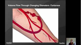 dialysis vascular access flow ultrasound doppler [upl. by Theodore366]