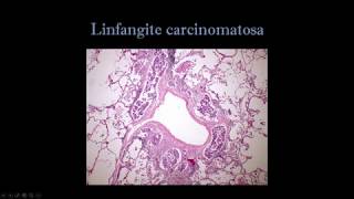 Linfangite carcinomatosa [upl. by Vihs]